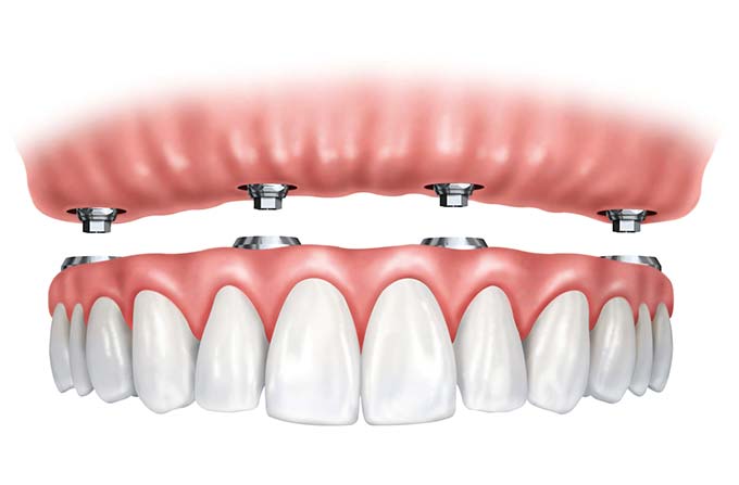 All-on-4 Dental Implant Procedure